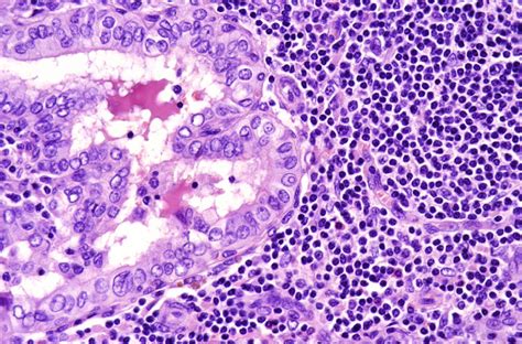 adenom folicular vs varianta foliculară a carcinomului papilar
